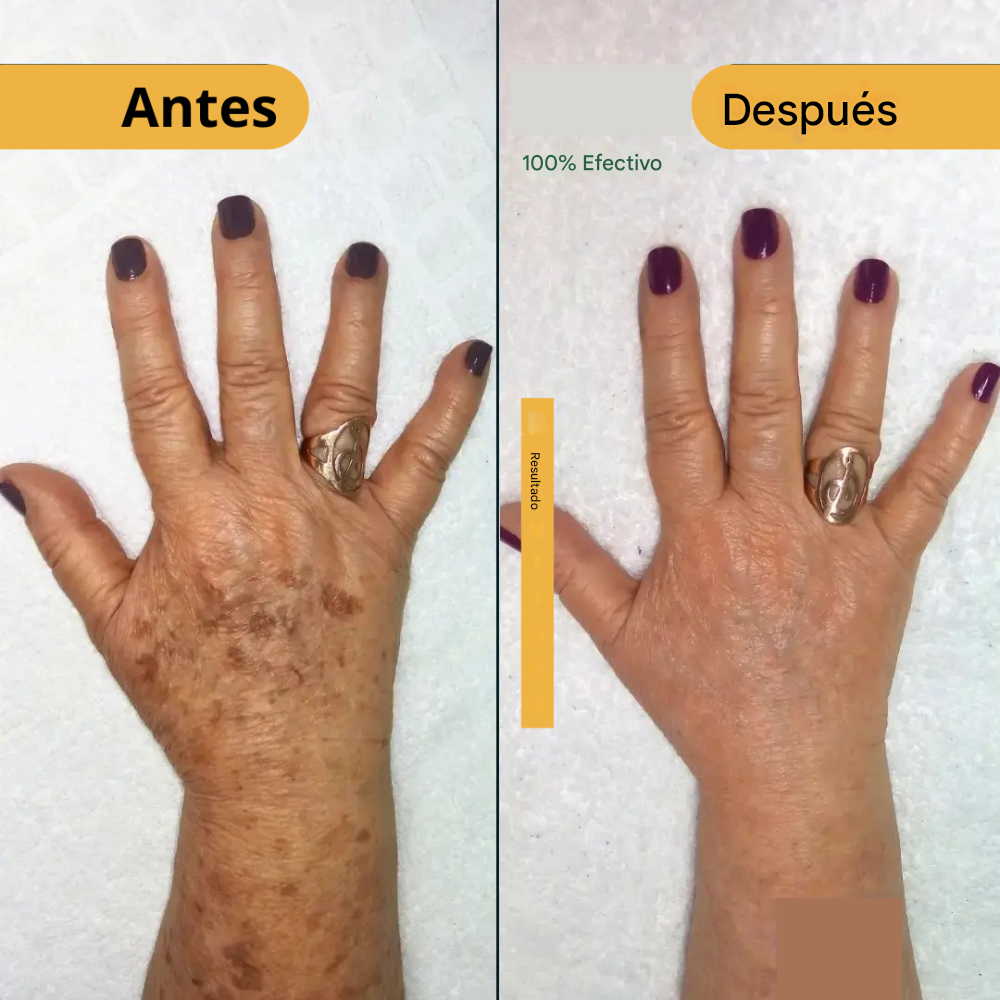 577! Spray Elimina Manchas de SOL - EDAD Y MELASMA! ¡50% DE DESCUENTO + ENVÍO GRATIS!