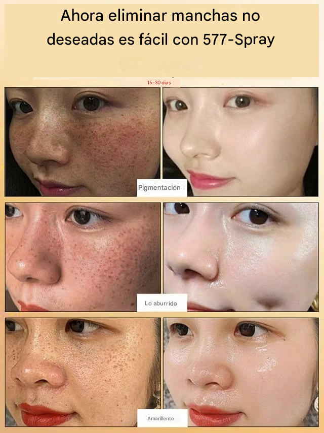 577! Spray Elimina Manchas de SOL - EDAD Y MELASMA! ¡50% DE DESCUENTO + ENVÍO GRATIS!