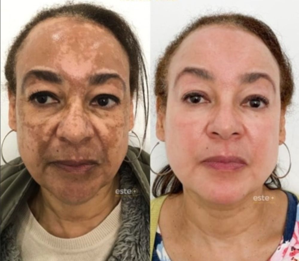 577! Spray Elimina Manchas de SOL - EDAD Y MELASMA! ¡50% DE DESCUENTO + ENVÍO GRATIS!