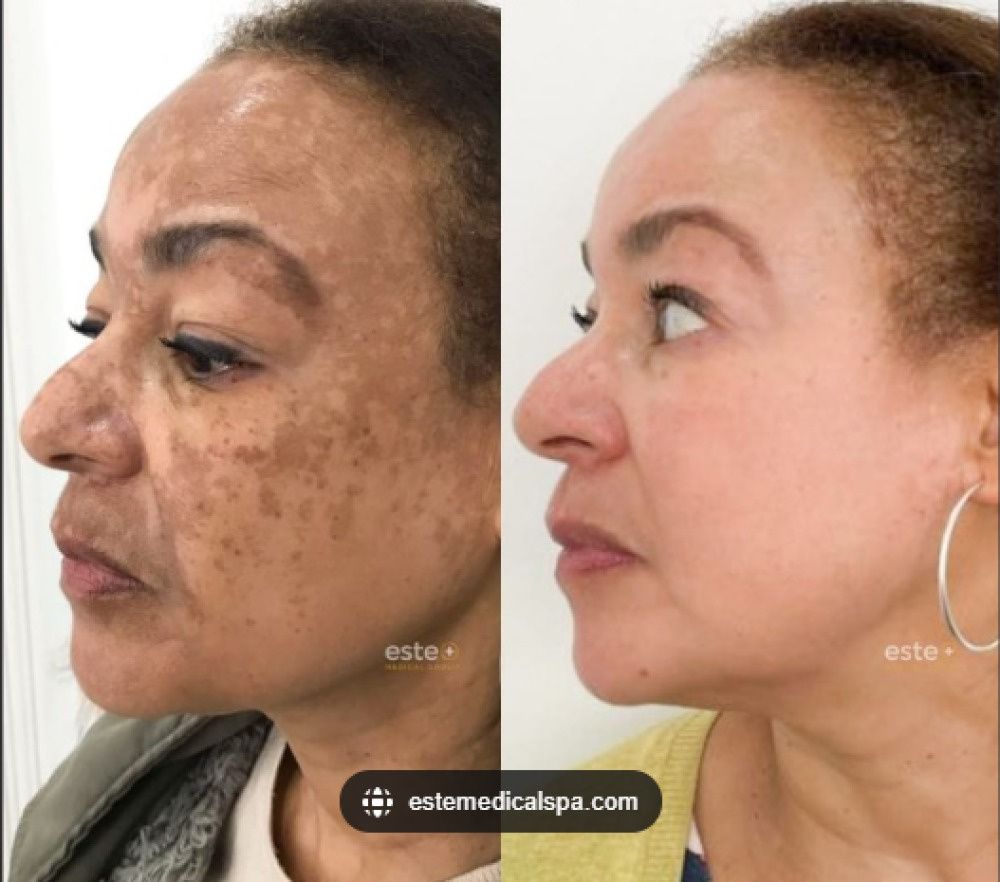 577! Spray Elimina Manchas de SOL - EDAD Y MELASMA! ¡50% DE DESCUENTO + ENVÍO GRATIS!
